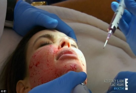 Kim K gets Vampire Facial, an age-defying facelift using her blood 