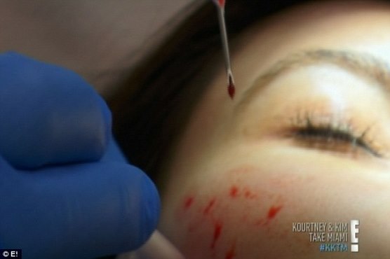 Kim K gets Vampire Facial, an age-defying facelift using her blood